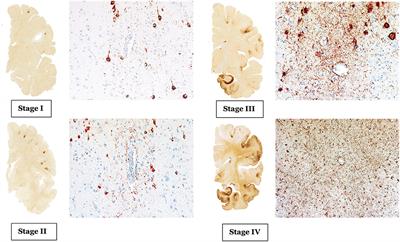 Chronic Traumatic Encephalopathy: A Brief Overview